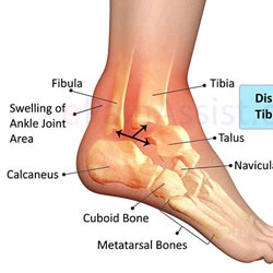 Best Ankle injury lawyers in VA