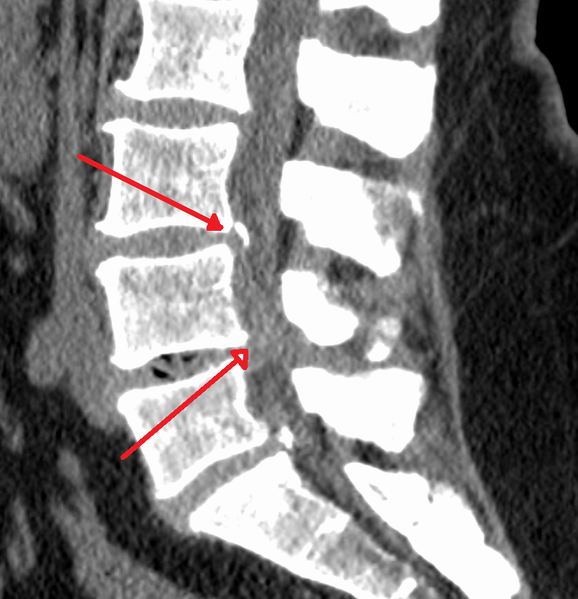 James Hellman, MD via Wikimedia Commons -- https://commons.wikimedia.org/wiki/File:SpinalCanalStenosisL3445.png