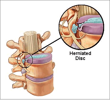 herniated, disc, low back, injury, injuries, sprain, spinal cord, VA, lawyer, attorney