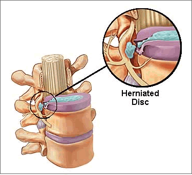 herniated, disc, low back, injury, injuries, sprain, spinal cord, VA, lawyer, attorney