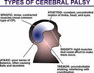 Best NC cerebral palsy lawyers