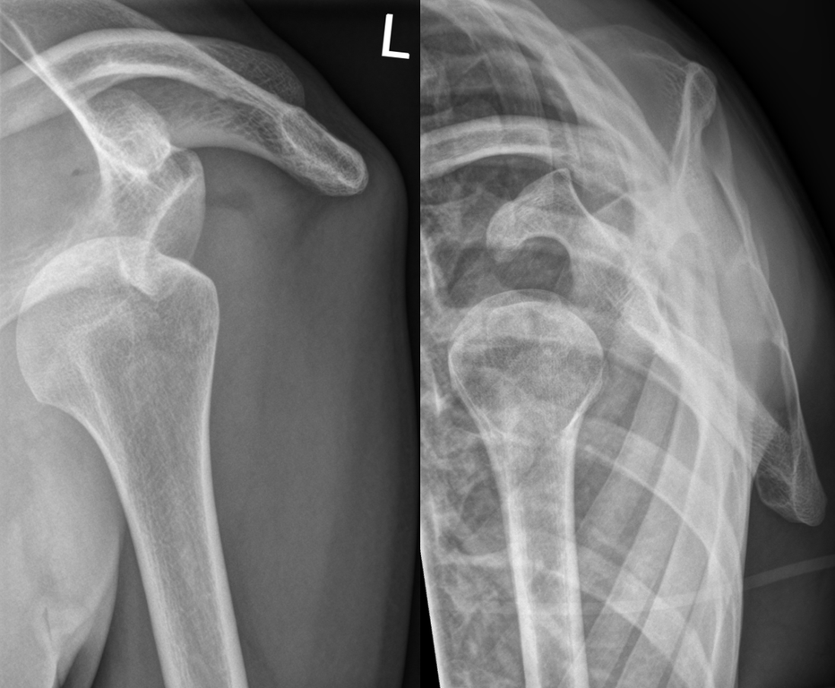 Creative Commons (CC-3.0) via Wikimedia Commons / Hellerhoff -- https://commons.wikimedia.org/wiki/File:Dislocated_shoulder_X-ray_08.png