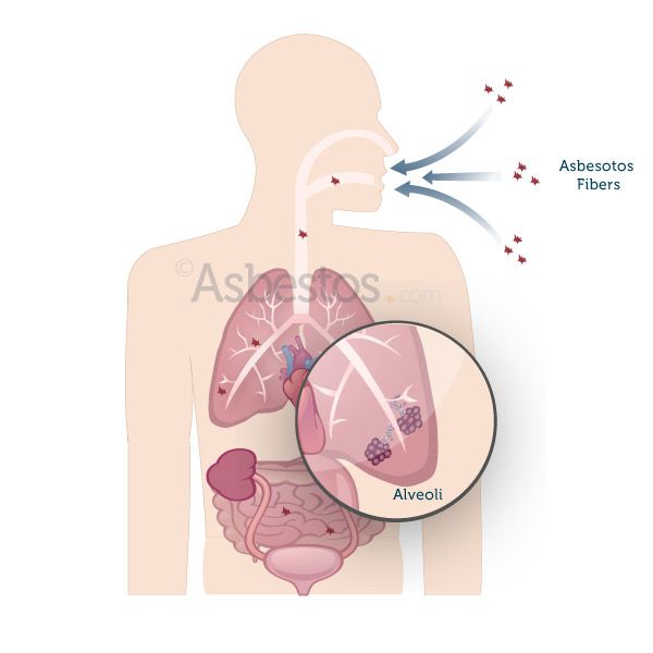 Reactive Mesothelial Hyperplasia vs Mesothelioma, Including Mesothelioma In  Situ A Brief Review